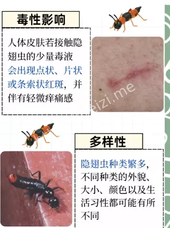 南阳儿童隐翅虫皮炎