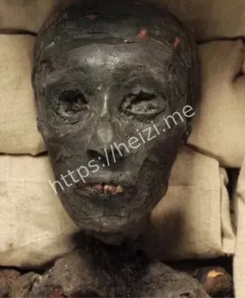 图坦卡蒙马蹄内翻足