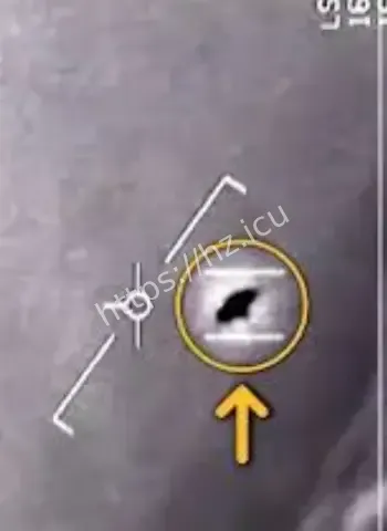 伯切特重磅爆料